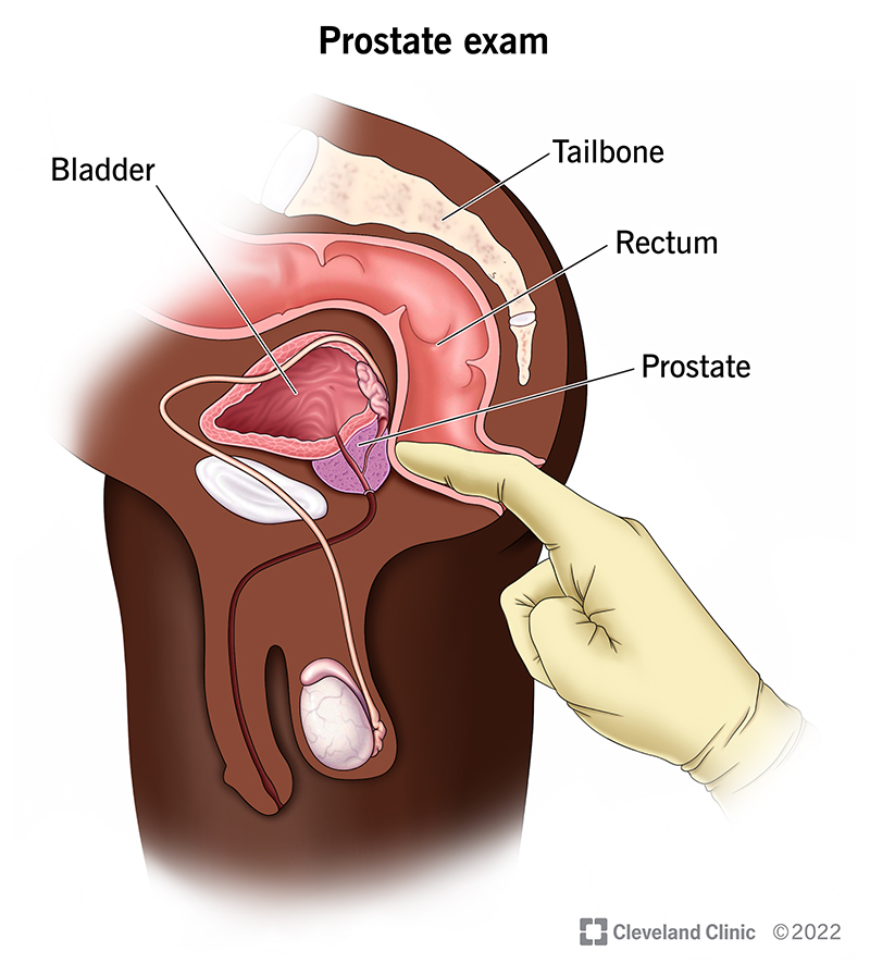 22764-prostate-exam.jpg