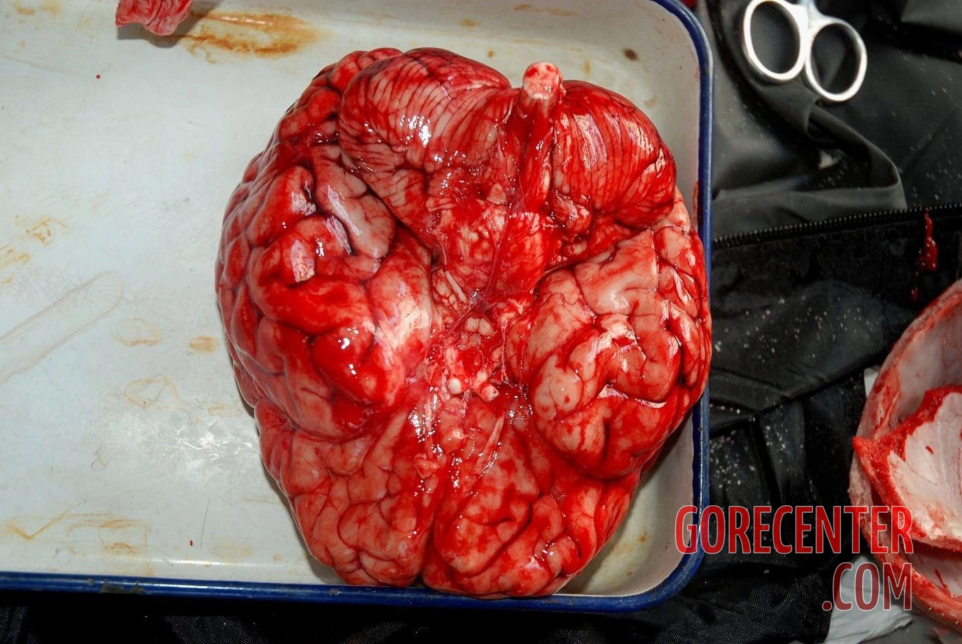 Autopsy-of-brain-after-stroke-1.jpg