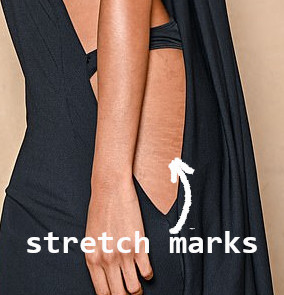 stretch marks3.jpg